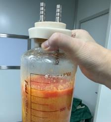和县水动力吸脂手术要做多久？